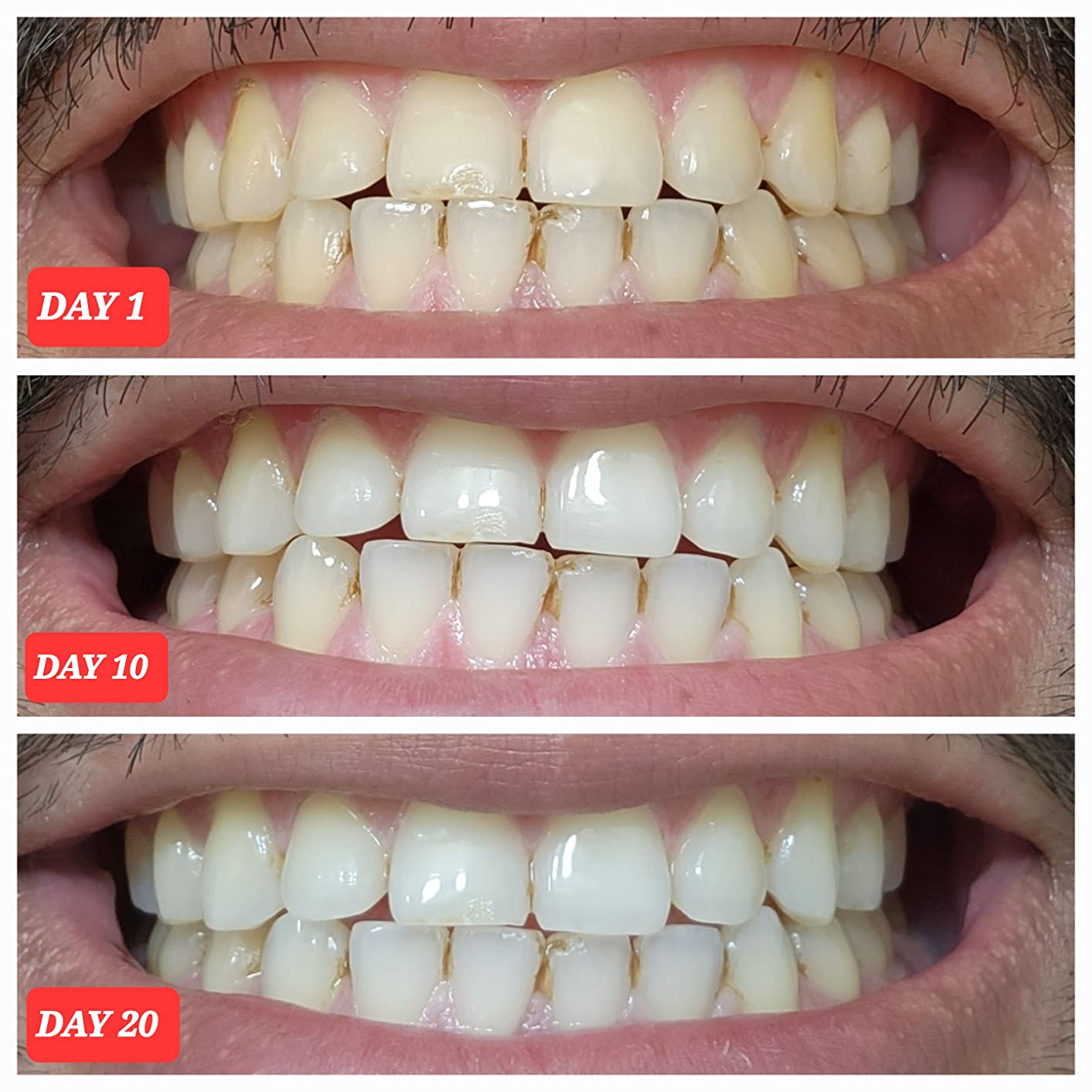 Crest 3D Whitestrips Professional Effects - Teeth Whitening Kit, 22 Treatments (20 + 2 Bonus), Each with 1 Upper/1Lower, 44 Strips - Crest 3DWhite Teeth Whitening Strips customer photo 1