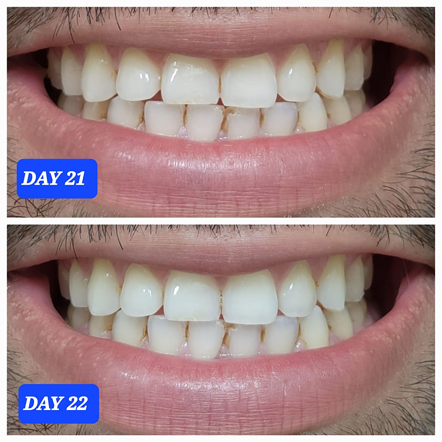 Crest 3D Whitestrips Professional Effects - Teeth Whitening Kit, 22 Treatments (20 + 2 Bonus), Each with 1 Upper/1Lower, 44 Strips - Crest 3DWhite Teeth Whitening Strips customer photo 2