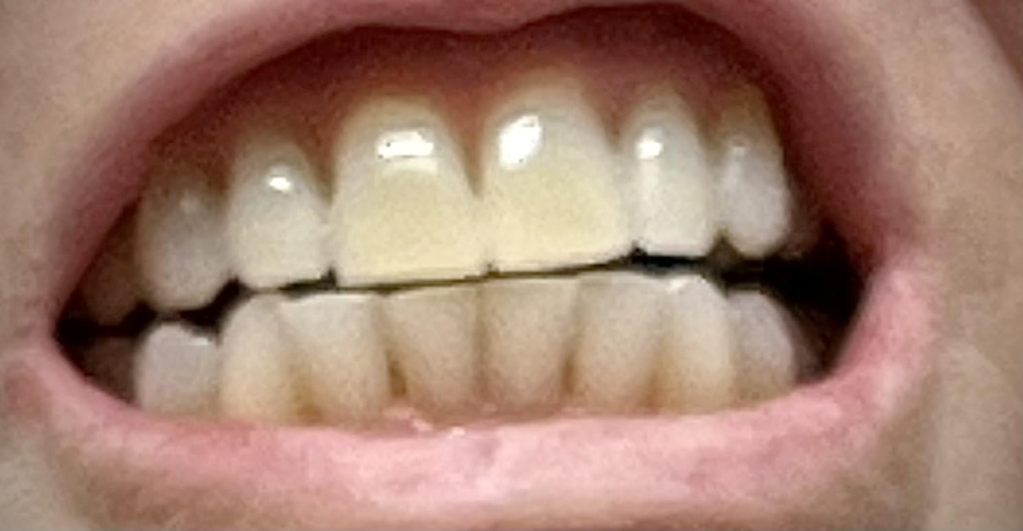 Crest 3D Whitestrips Express Whitening + LED Light - Teeth Whitening Kit, 1 Light + 10 Treatments, Each with 1 Upper/1Lower, 20 Strips - Crest 3DWhite Teeth Whitening Strips customer photo 1