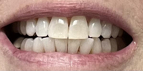 Crest 3D Whitestrips Express Whitening + LED Light - Teeth Whitening Kit, 1 Light + 10 Treatments, Each with 1 Upper/1Lower, 20 Strips - Crest 3DWhite Teeth Whitening Strips customer photo 2