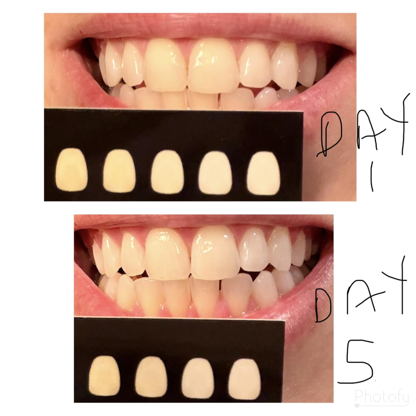 Novashine Professional Teeth Whitening Kit: Advanced Blue LED Light, Concentrated Peroxide Gel, Smartphone Adapter, Travel Bag customer photo 1