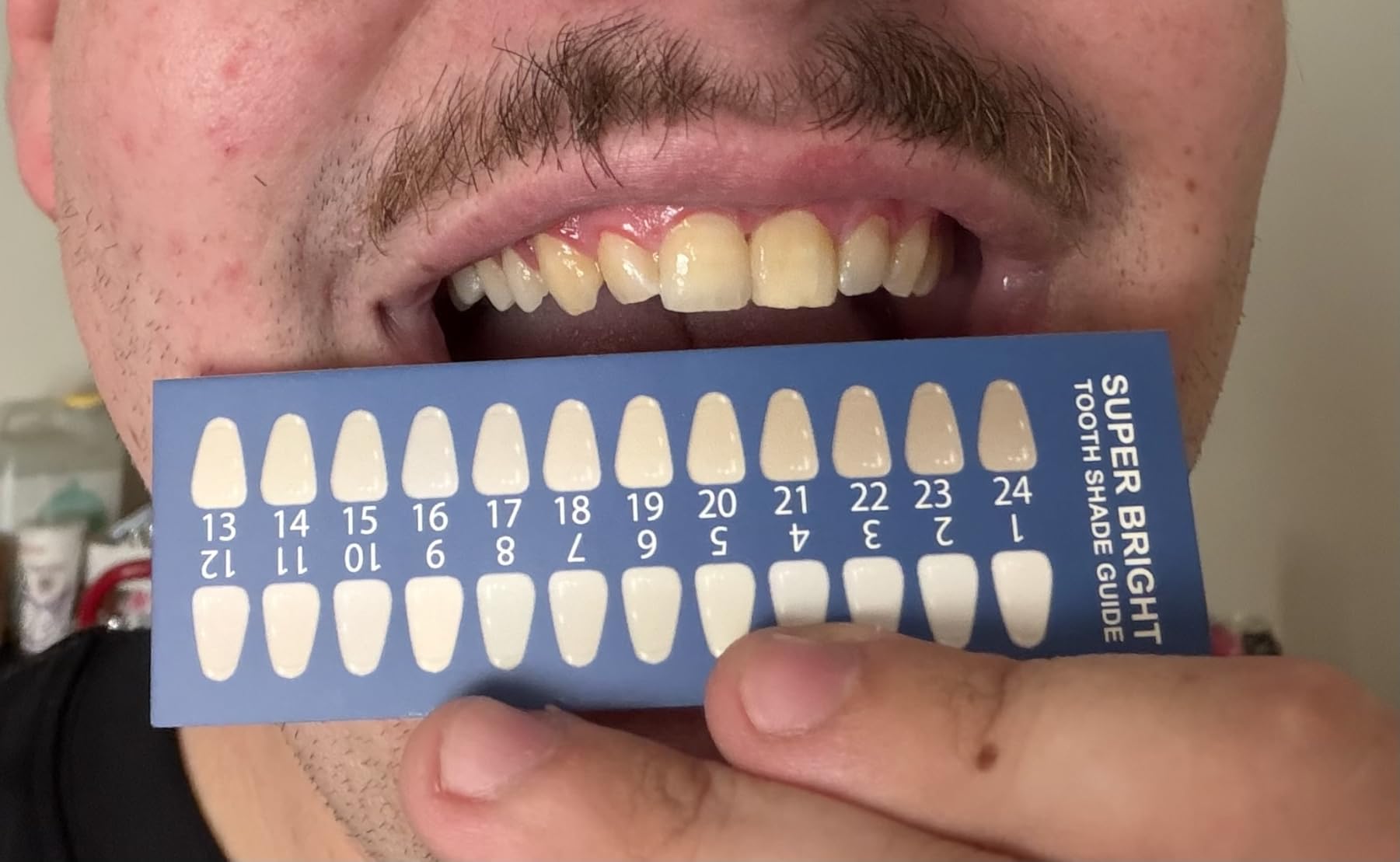 iSmile Teeth Whitening Kit - LED Light, 35% Carbamide Peroxide, (3) 3ml Gel Syringes, (1) Remineralization Gel, and Tray. customer photo 2