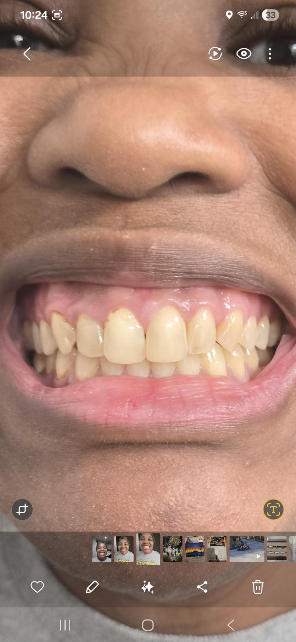Crest 3D Whitestrips Professional Effects + LED Light - Teeth Whitening Kit, 1 Light + 20 Treatments, Each with 1 Upper/1Lower, 40 Strips - Crest 3DWhite Teeth Whitening Strips customer photo 2