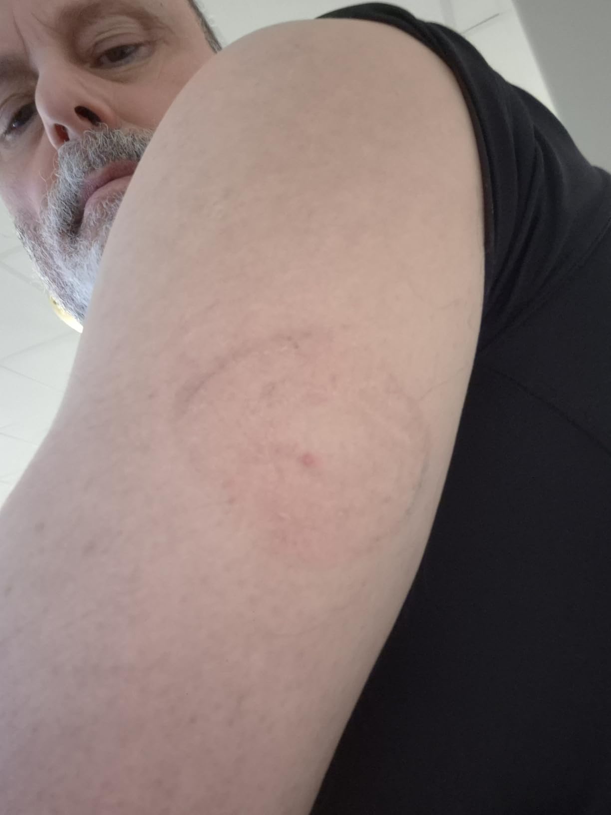 Stelo Glucose Biosensor & App by Dexcom - A Leader in Continuous Glucose Monitoring (CGM). 24/7 Tracking & Personalized Insights to Reveal Patterns. 2-Pack (Up to 15 Days Each). iOS & Android. customer photo 1