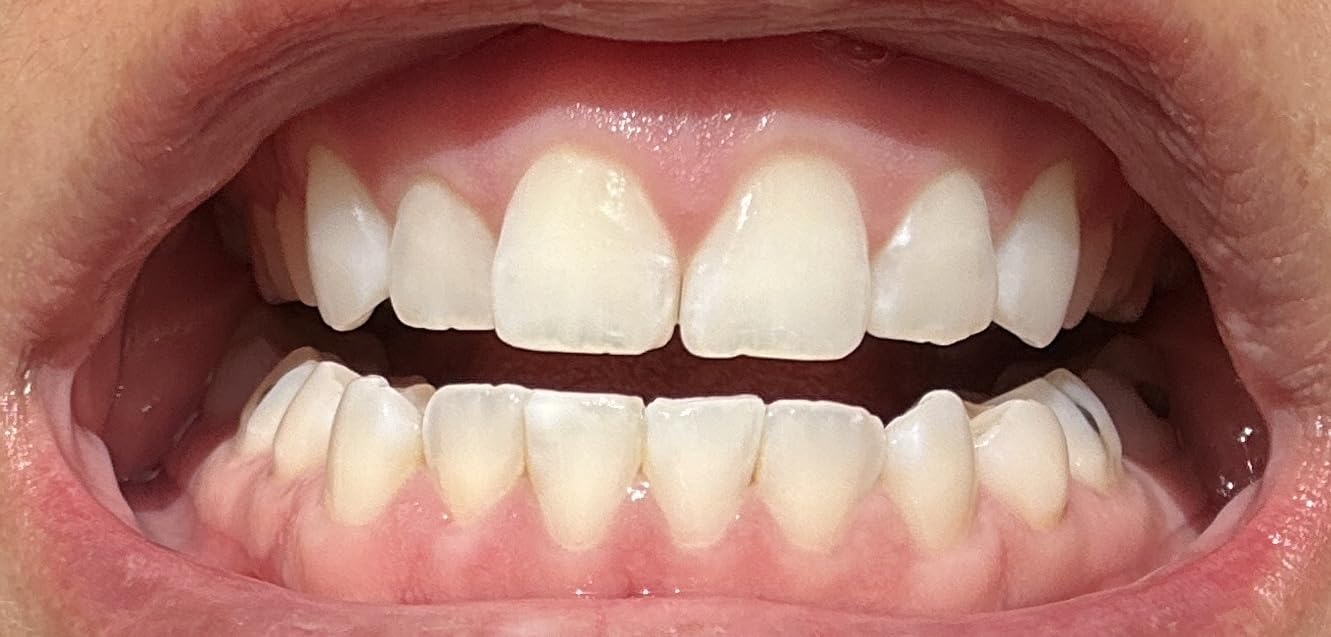 Opalescence GO 15 Mint Whitening Bundle - (7 Treatments) Hydrogen Peroxide Prefilled Teeth Whitening Trays and Travel Whitening Sensitivity Toothpaste 1 Oz - Mint Flavor - 6288-1 customer photo 1