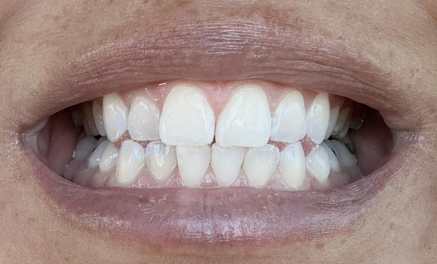 Opalescence GO 15 Mint Whitening Bundle - (7 Treatments) Hydrogen Peroxide Prefilled Teeth Whitening Trays and Travel Whitening Sensitivity Toothpaste 1 Oz - Mint Flavor - 6288-1 customer photo 2