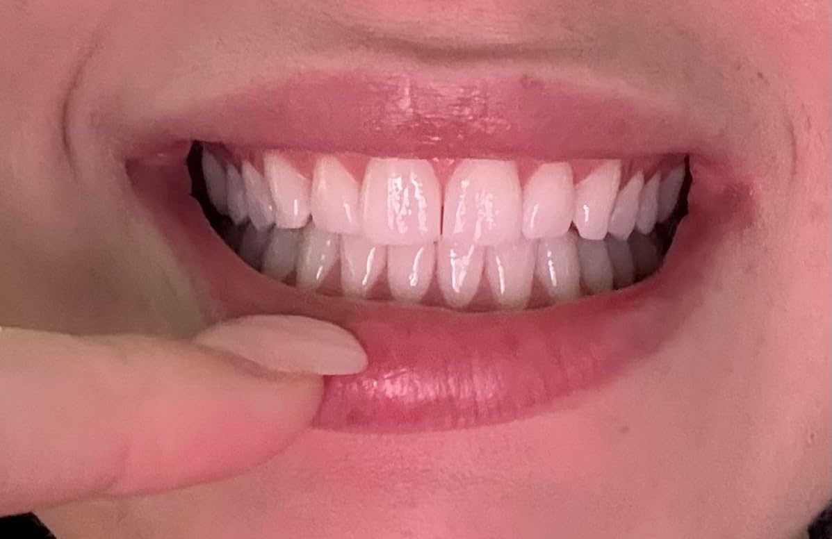 SmileDirectClub Teeth Whitening Kit with LED Light - 4 Pack Gel Pens - Professional Strength Hydrogen Peroxide customer photo 1