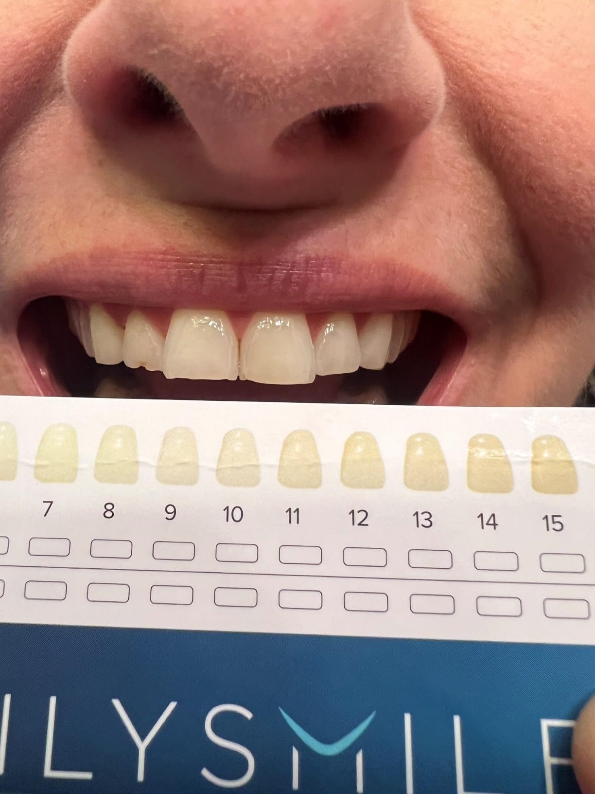 Teeth Whitening Kit with LED - Formulated for Sensitive Teeth, Hands-Free, Waterproof LED Light and 4 Gel Pens, Instant Results customer photo 1