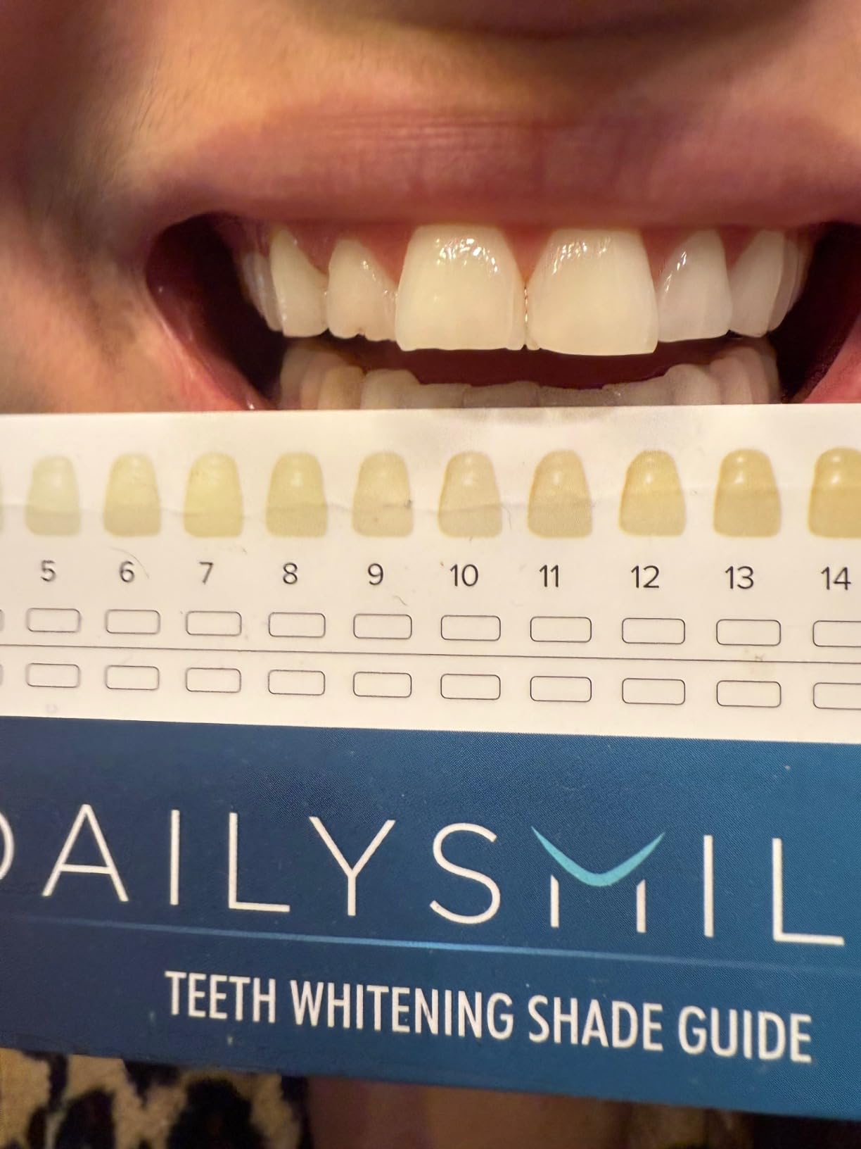 Teeth Whitening Kit with LED - Formulated for Sensitive Teeth, Hands-Free, Waterproof LED Light and 4 Gel Pens, Instant Results customer photo 2