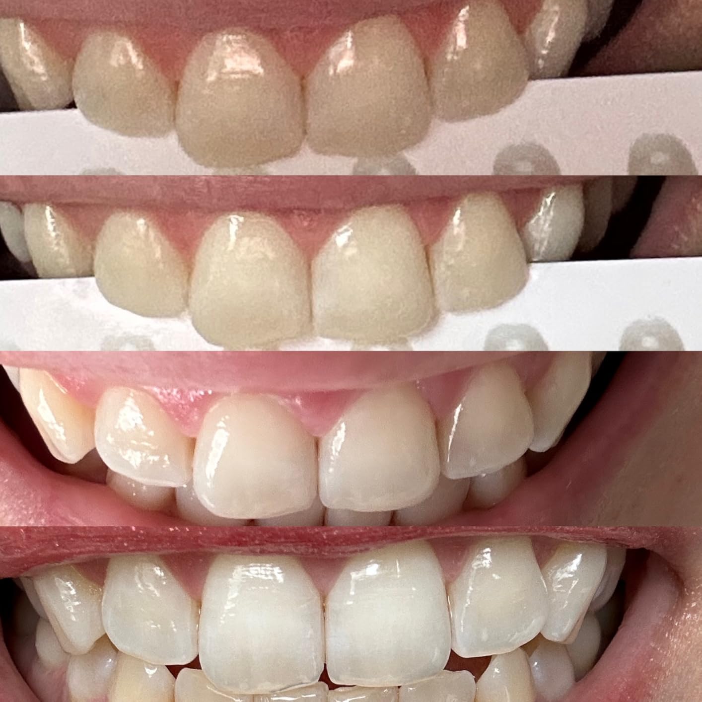 PurelyWHITE DELUXE Teeth Whitening Kit, Complete LED Teeth Whitening, 15+ Treatments, (3) 3ml Whitening Gel Syringes, Whiter Smile in 7 Minutes customer photo 1