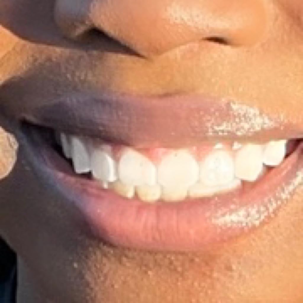 Whitebite Pro Teeth Whitening Kit for Sensitive Teeth - 32X LED Light + 35% Carbamide Peroxide Gel + Remineralizing Gel | Dental-Grade Whitening at Home Flavor Strawberry customer photo 2