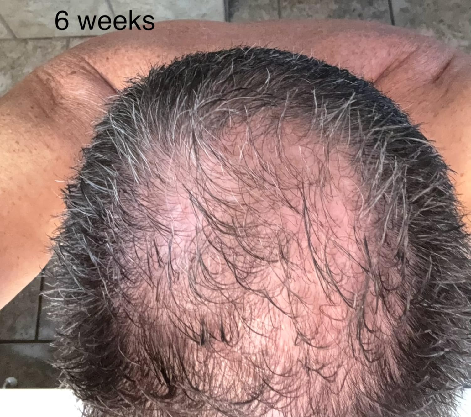 iRestore Professional Laser Red Light Therapy for Hair Growth System - FDA Cleared Hair Loss, Hair Thinning & Alopecia Treatment for Men & Women - 282 Lasers & LEDs customer photo 1