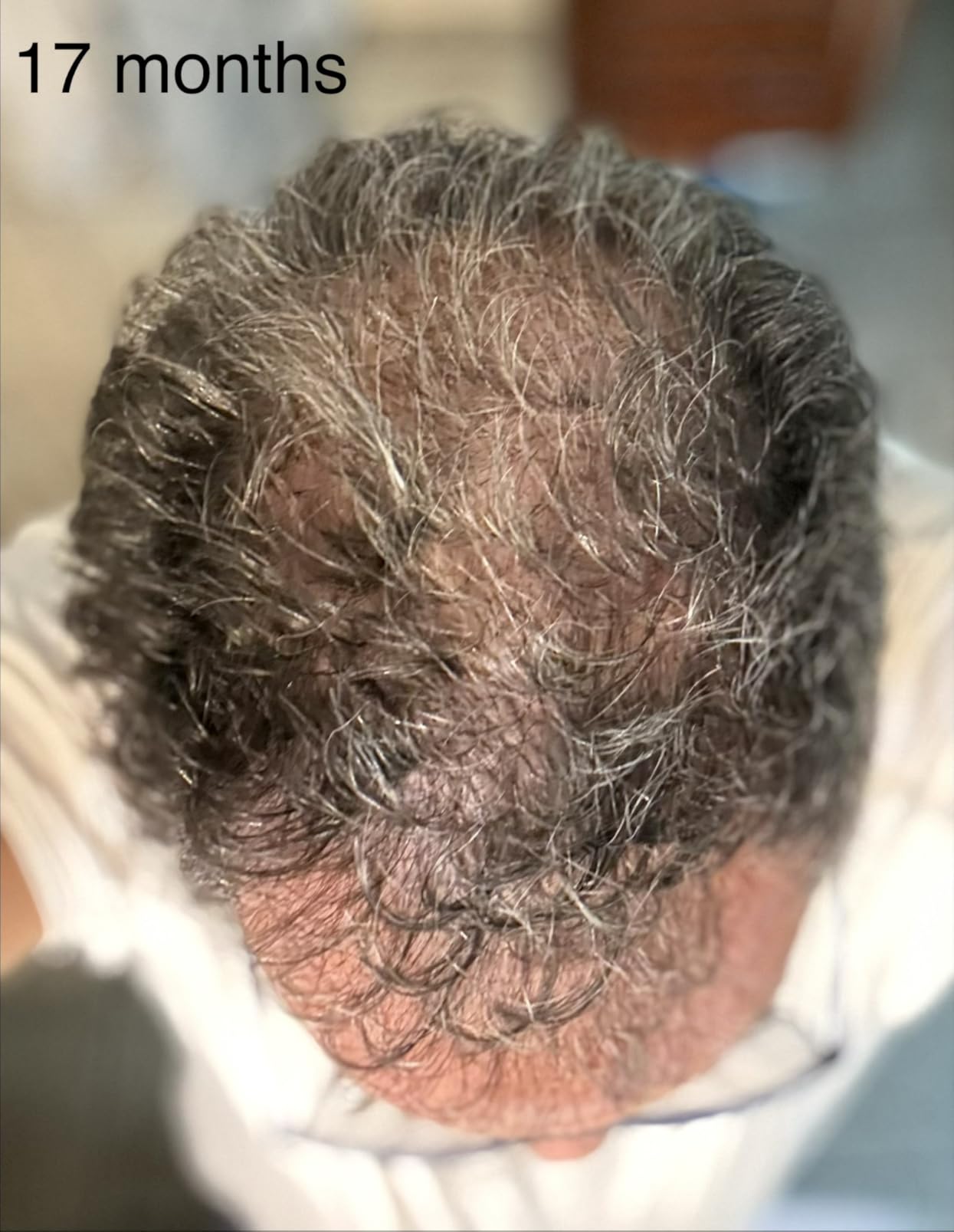 iRestore Professional Laser Red Light Therapy for Hair Growth System - FDA Cleared Hair Loss, Hair Thinning & Alopecia Treatment for Men & Women - 282 Lasers & LEDs customer photo 2
