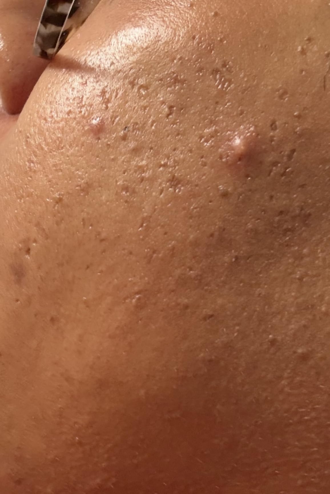 La Roche-Posay Effaclar Adapalene Gel 0.1% Acne Treatment, Retinoid Cream, Acne Medication Gel for Blackheads & Whiteheads, Oil Free, Helps Clear and Prevent Blemishes & Clogged Pores customer photo 1