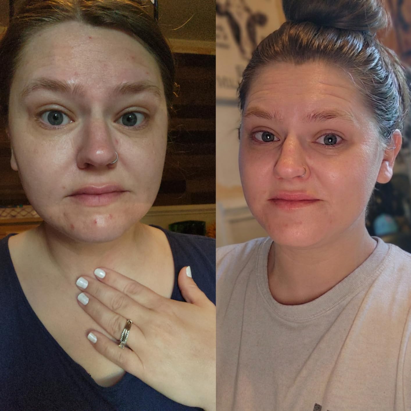 The Ordinary The Acne Set, 3-Step Skin Regimen with Glucoside Foaming Cleanser, Salicylic Acid 2% Solution, and Natural Moisturizing Factors + Beta Glucan customer photo 1