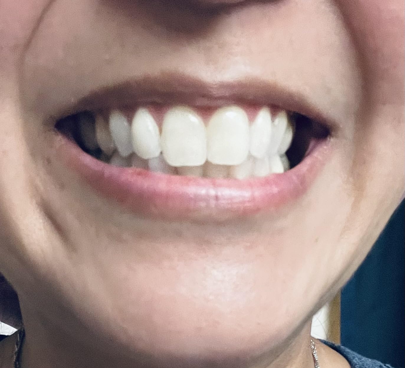 Philips Sonicare DiamondClean Smart 9300 Electric Toothbrush, App, Pressure Sensor, 12 Brushing Settings, Travel Case, White, HX9903/05 customer photo 1